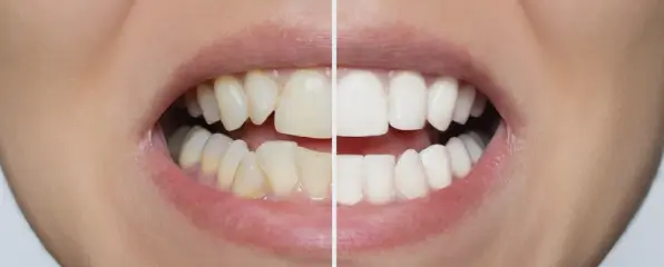 before-after